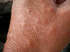 Mückenbearbeitete Hand von Fisch-Man